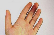 Ушиб сустава пальца руки: что делать, лечение травмы большого пальца