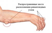 Бронхит у ребенка симптомы и лечение с температурой