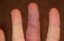 Вывих пальца на руке (большого, мизинца, безымянного): что делать и как вправить растяжение в домашних условиях