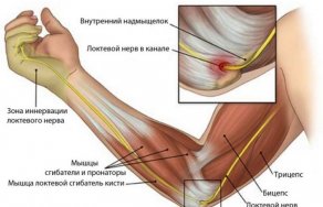 Растяжение локтевого сустава симптомы и лечение