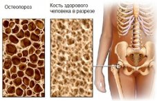 Артроз голеностопного сустава симптомы лечение лфк