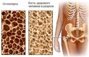 Кто лечил мастопатию народными средствами