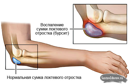 Болит локоть в суставе - что делать, к какому врачу обращаться Боль в локтевом суставе причины, диагностика и методы лечения