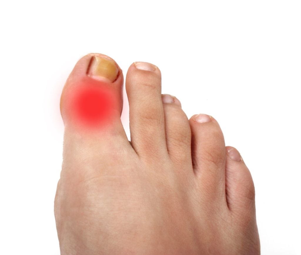 Артроз большого пальца ноги: причины, признаки (фото), лечение ...