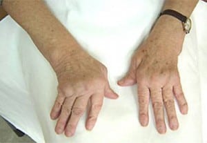 Лечение остеоартроза кистей рук и суставов пальцев