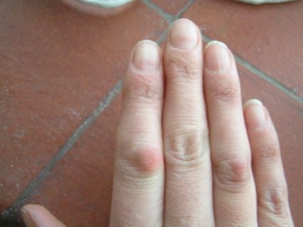 Деформация суставов пальцев рук: лечение искривления
