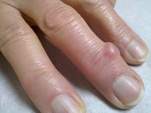 Шишки на пальцах рук: причины, лечение, фото сустава