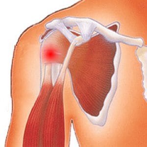 Тендинит плечевого сустава: симптомы, лечение плеча