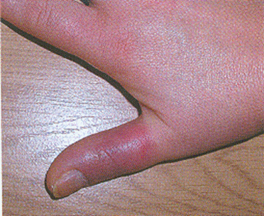 Воспаление суставов пальцев рук: лечение фаланг