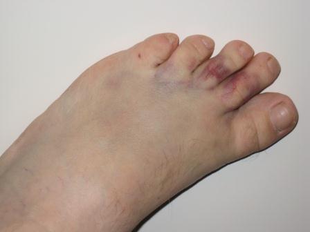Вывих пальца на ноге: симптомы и лечение растяжения