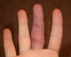 Болезнь суставов пальцев рук: лечение заболеваний