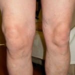 лечение артроза колена 