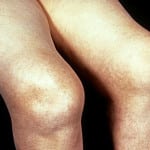 ревматоидный артрит колен 