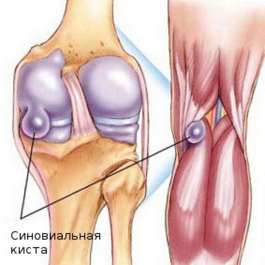 Киста латерального мениска коленного сустава лечение