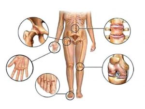 Что делать, если хрустят суставы по всему телу вероятные причины и варианты лечения