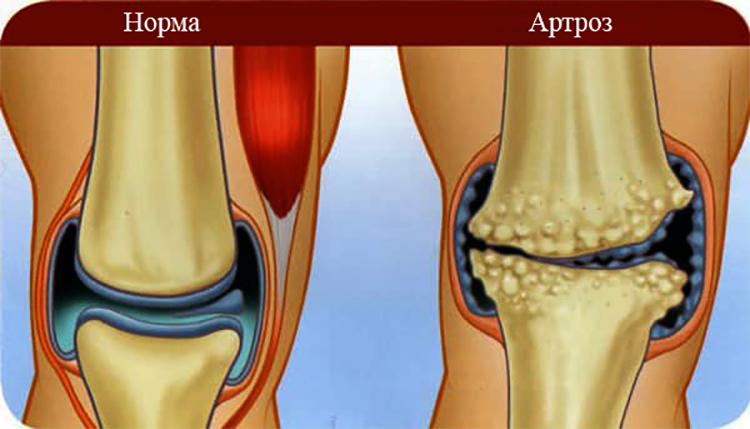 Витамины при артрозе коленного сустава