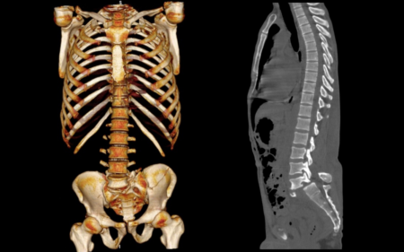УЗИ тазобедренных суставов у грудных детей норма и патология углов