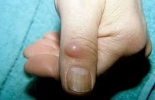 Гигрома на пальце руки: фото и лечение сустава