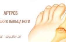 Артроз большого пальца ноги лечение народными средствами