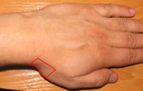 Болезнь де Кервена: симптомы, причины, лечение теносиновита кисти руки
