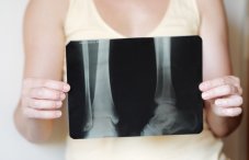 Рентген голеностопного сустава: фото рентгенограммы голеностопа