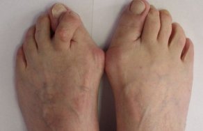 Как лечить шпоры на пальцах ног: фото большого пальца