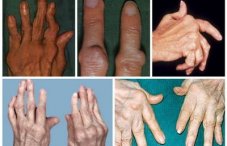 Артрит на руках: симптомы, лечение и фото суставов