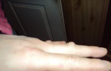 Шишки на пальцах рук (большом, среднем, указательном, мизинце): как избавиться и чем лечить суставы