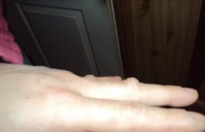 Шишки на пальцах рук (большом, среднем, указательном, мизинце): как избавиться и чем лечить суставы