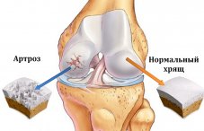 Что такое деформирующий остеоартроз коленного сустава: диагноз ДОА 1 и 2 степени