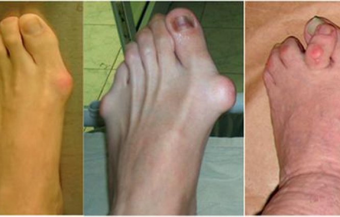 Нарост на суставе пальца ноги: лечение шишки