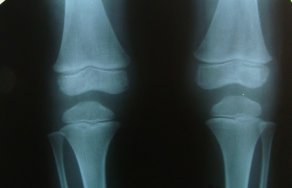 Что такое артрит суставов: фото, симптомы и лечение заболевания