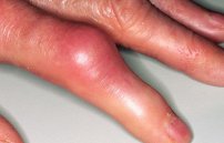 Воспалился сустав на пальце руки: лечение воспаления