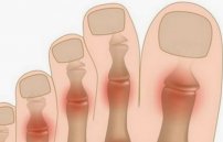 Воспаление сустава на большом пальце ноги: лечение, симптомы, фото
