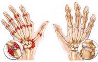 Воспаление суставов кисти рук (лучезапястных): лечение и профилактика