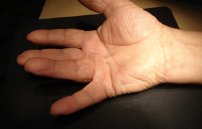 Контрактура пальцев рук: лечение кисти от контрактуры Дюпюитрена