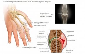 Классификация ревматоидного артрита: стадии заболевания и профилактика