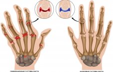 Деформация суставов: лечение искривления пальцев рук