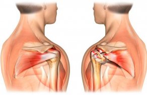 Операция на плечевой сустав: операционное лечение плеча (артроскопия)