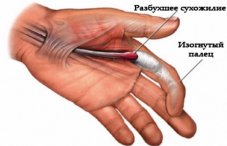 Почему болит палец на руке при сгибании (большой, средний): причины боли в суставах