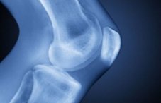 Жидкость в коленном суставе: что делать при скоплении в колене под чашечкой, симптомы, профилактика