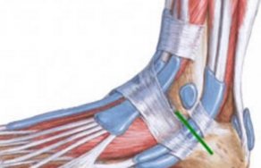 Что делать при растяжении связок на ноге: как лечить разрывы
