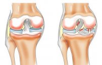 Что такое хондромаляция надколенника: симптомы и лечение коленного сустава