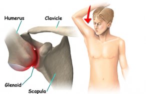 Подвывих плечевого сустава: признаки, симптомы и лечение плеча