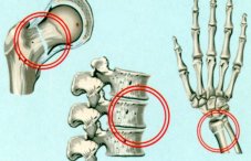 Что такое остеопороз: причины, симптомы (признаки) и лечение заболевания костей
