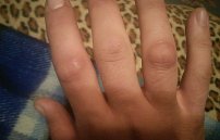 Нарост на суставе пальца руки и запястье: лечение и удаление