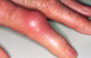 Бурсит пальца руки: лечение и фото сустава