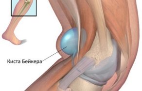 Синовиальная киста (гигрома ноги): лечение и фото