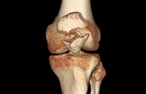 Хруст в колене при ходьбе: почему хрустит коленный сустав