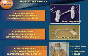 Диагностика и лечение дисплазии тазобедренных суставов